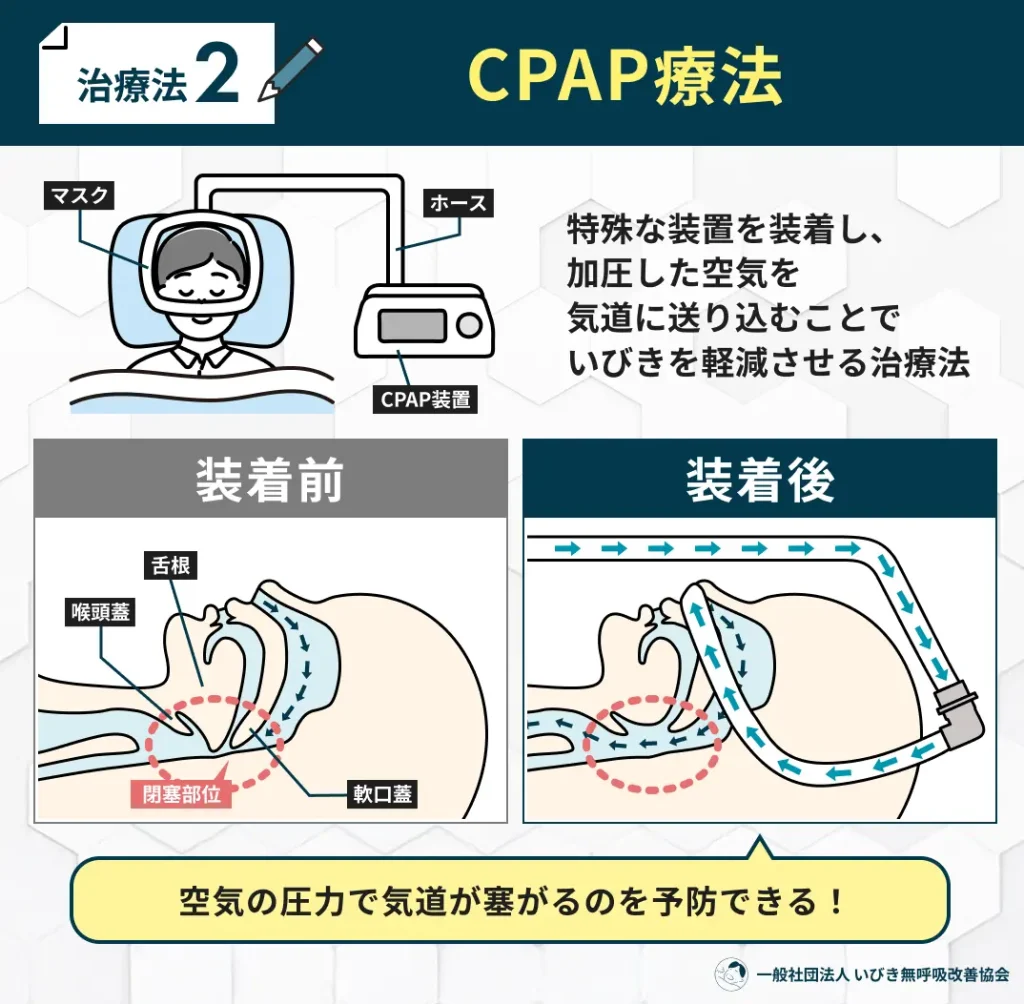 CPAP療法
