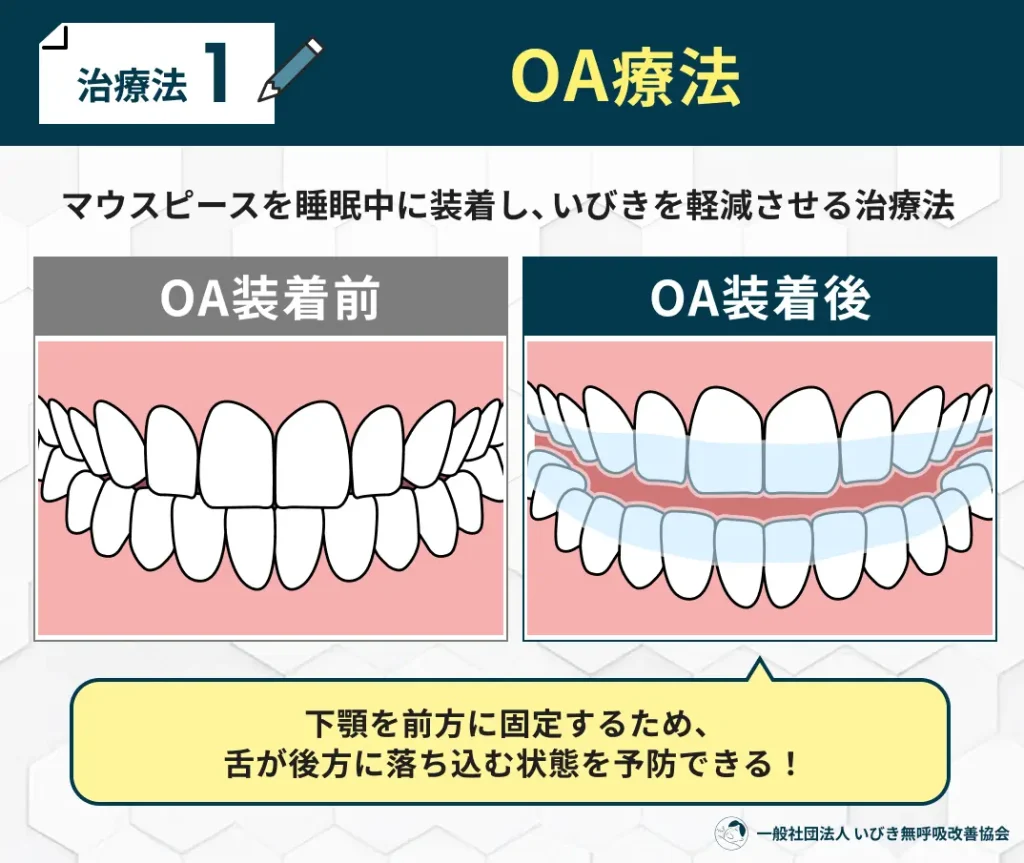 OA療法