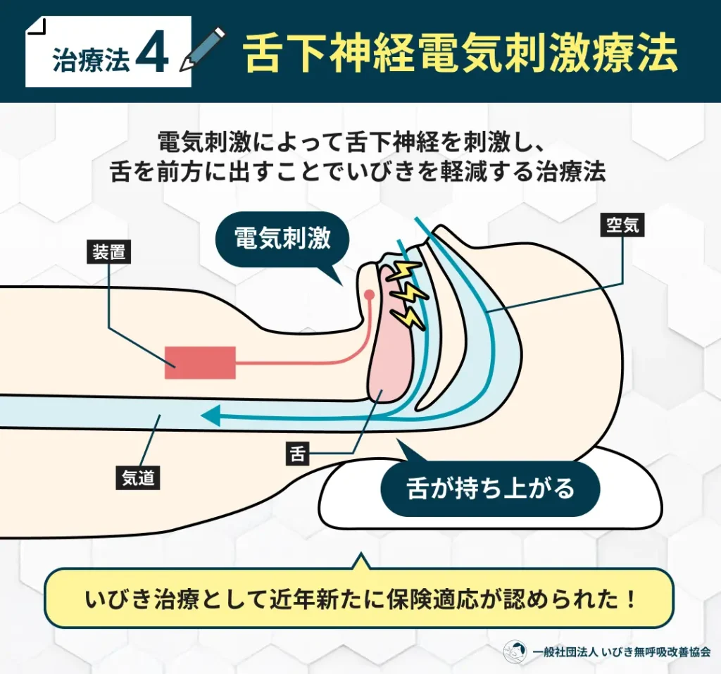 舌下神経電気刺激療法