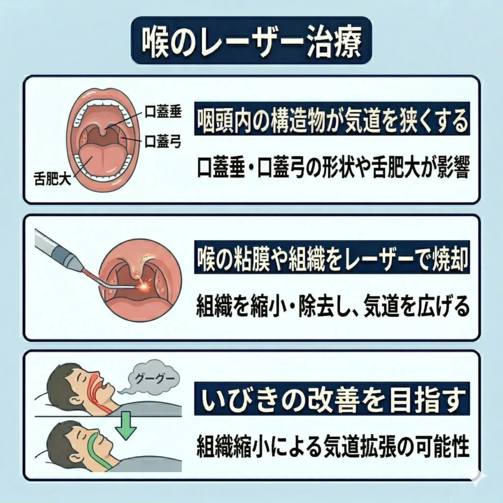 喉のレーザー治療