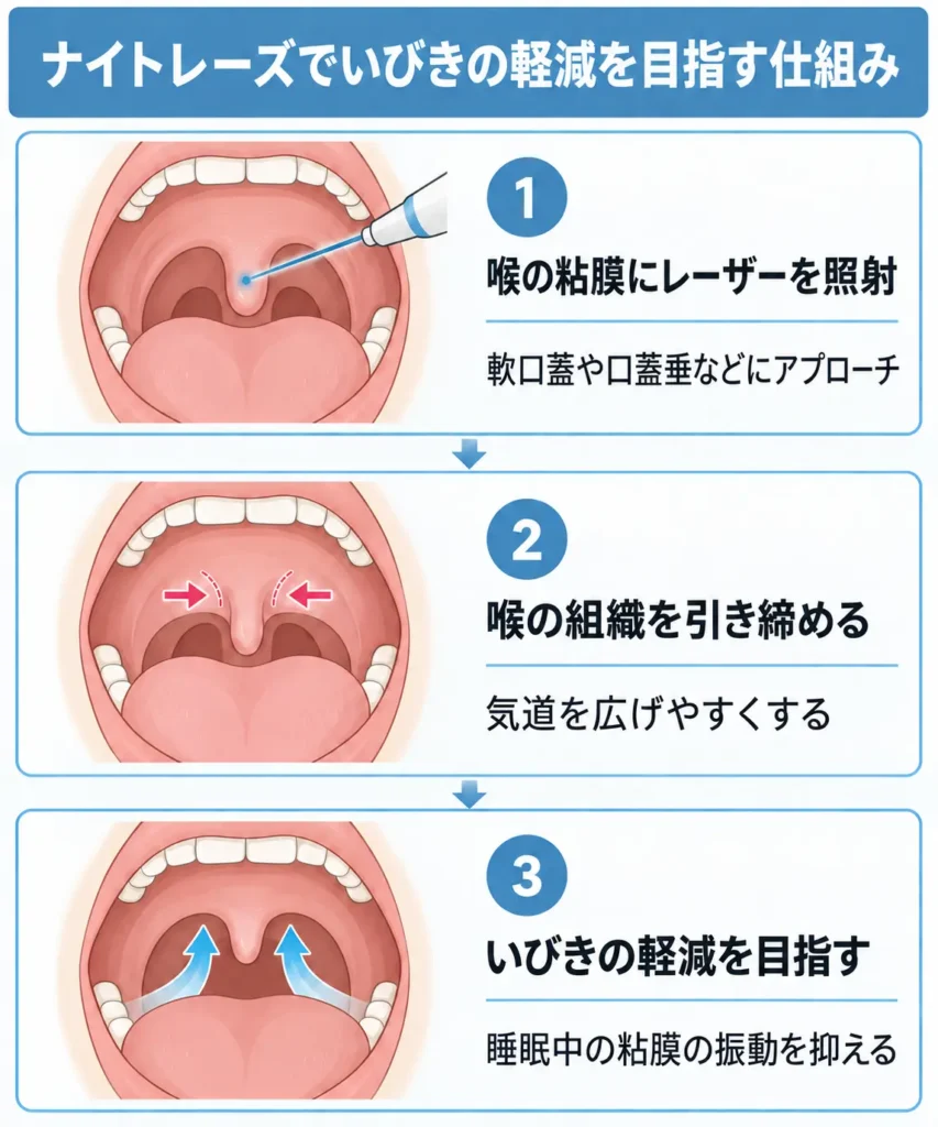ナイトレーズは喉の組織を引き締めていびきの軽減を目指す治療